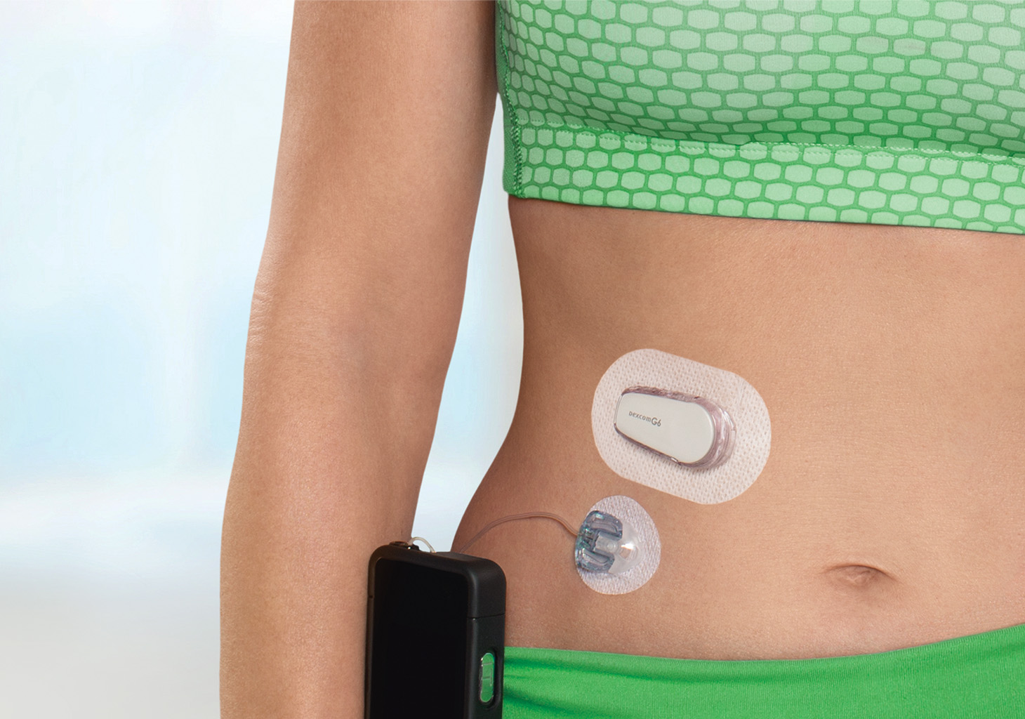 Placement of Dexcom G6 CGM Sensor on Same Side as t:slim X2 Insulin Pump