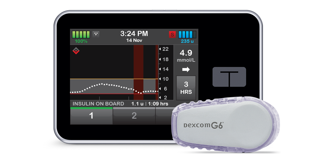 dexcom g6 tandem pump