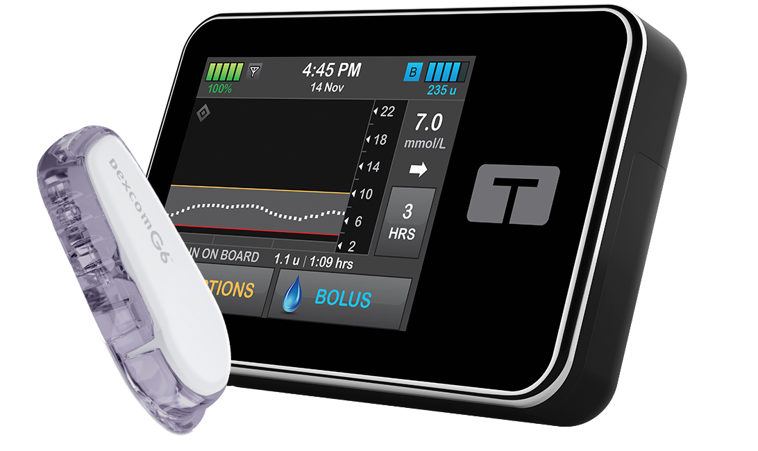 Abbott integrates CGM into Tandem's automated insulin pump